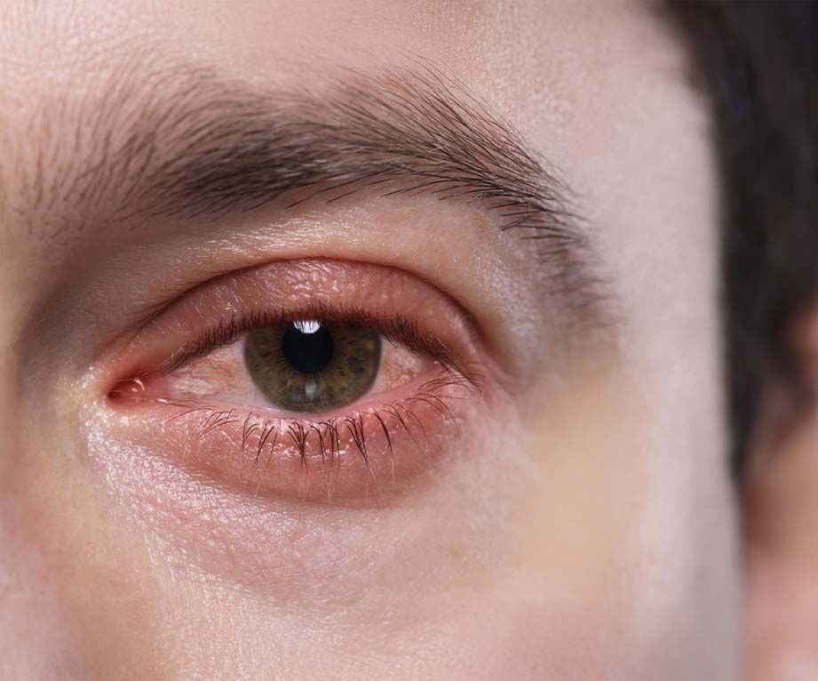 What Is Childhood Nearsightedness (Myopia)?