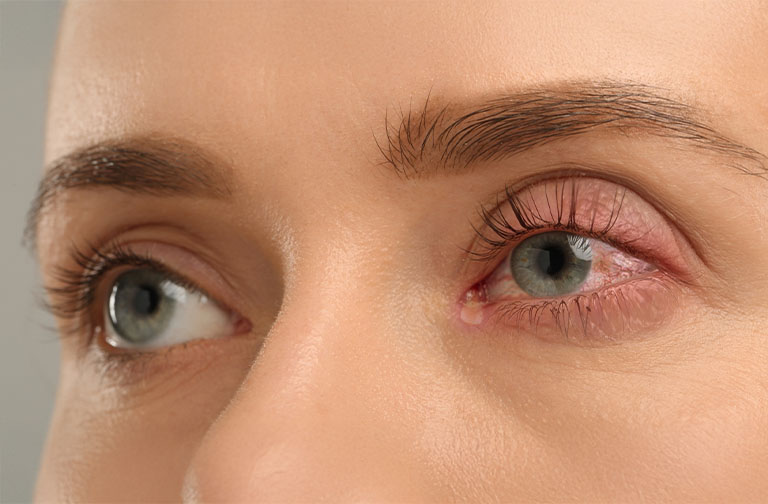 What Is Blepharitis?