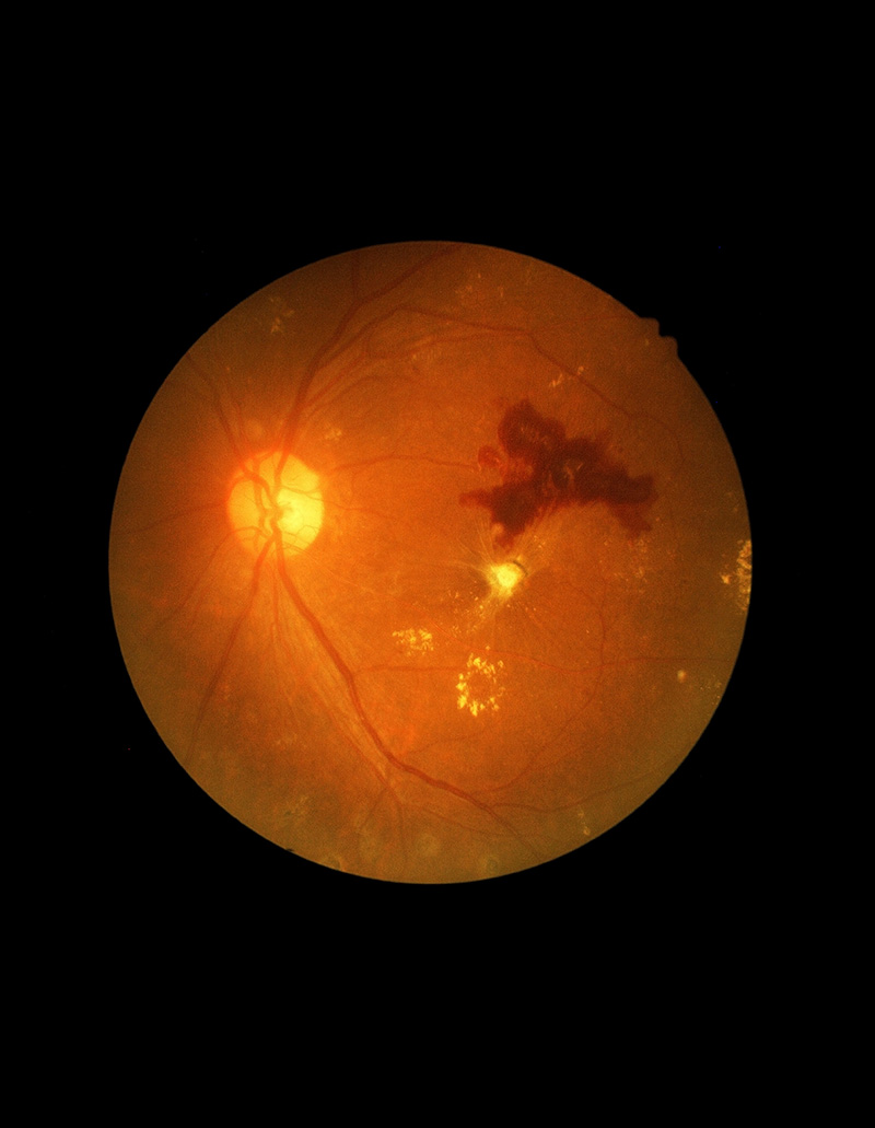 diabetic-retinopathy